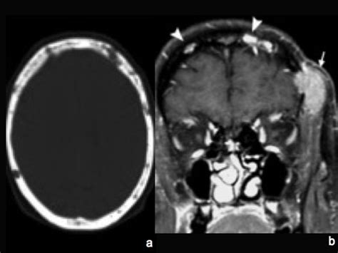 Myeloma Lytic Skull Lesions On Non Enhanced Ct Scan A Of The Same