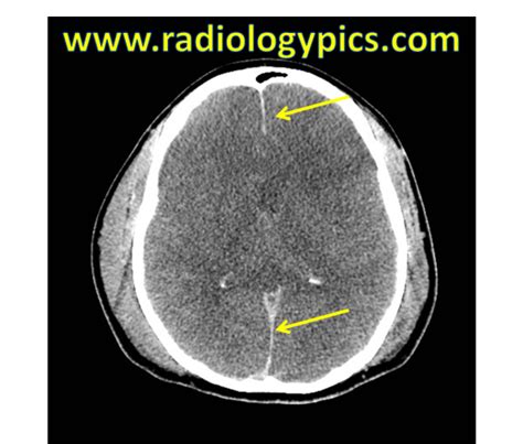 Diffuse Cerebral Edema Radiologypicscom