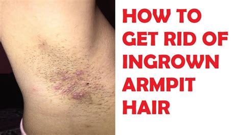 How To Get Rid Of Ingrown Armpit Hair In Only 5 Minutes Youtube