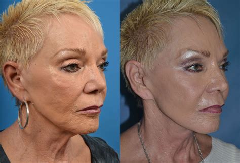 Patient 122406487 Profile Neck Lift Before And After Photos Clevens