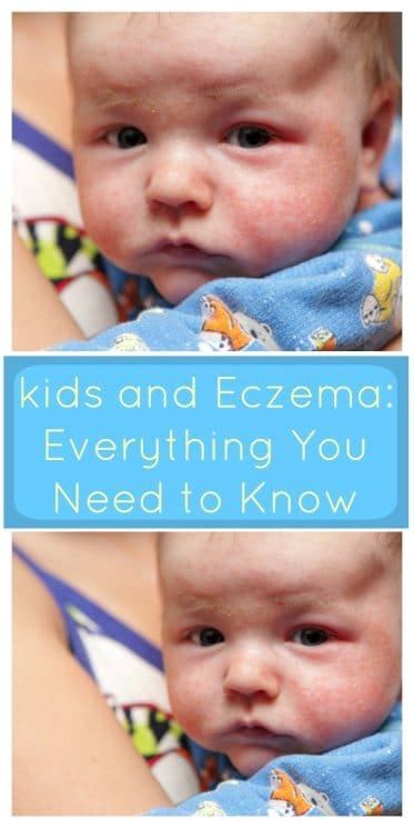Kids And Eczema Everything You Need To Know Super Healthy Kids