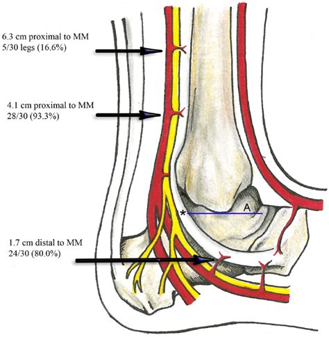 Arterial Anatomy Of The Tibialis Posterior Tendon Mary Claire Manske