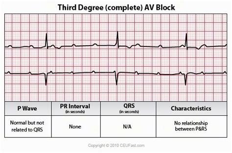 It may be due to progressive fatigue of av nodal cells as. There is complete heart block that none of the impulses ...