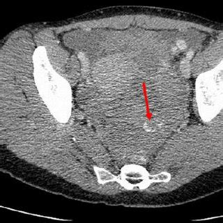 Pdf Postcoital Hemoperitoneum Caused By Ruptured Corpus Luteal Cyst A Hidden Etiology