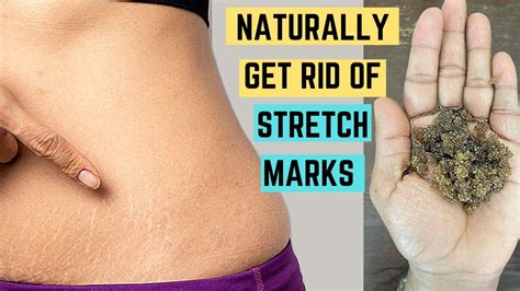 Get Rid Of Stretch Marks Permanently Naturally How To Reduce Stretch