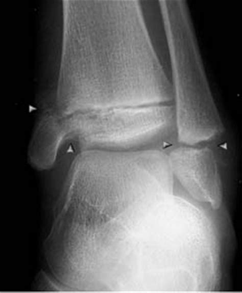 Ankle Fractures Radiology