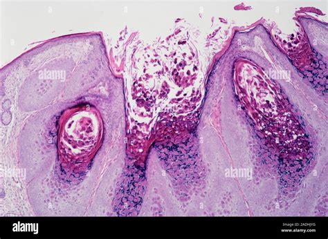 Molluscum Contagiosum Light Micrograph Of A Section Through Human Skin