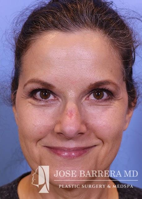 Scar Revision Case 17701 Dr Jose Barrera San Antonio Facial Plastic