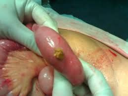 Intestinal obstruction | Belgium| PDF | PPT| Case Reports ...