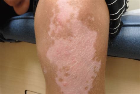 Hypopigmented And Depigmented Lesions Vitiligo Pediatric Dermatology