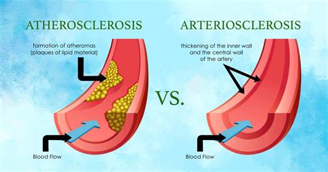 Atherosclerosis Vs Arteriosclerosis Similarities And Contrast