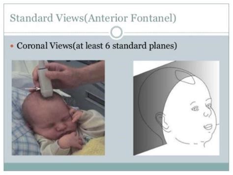Neonatal Head Ultrasound Procedure And Images New Health Advisor