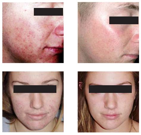 Acne Laser Treatments Laser Acne Treatment Or Laser Treatment For Acne
