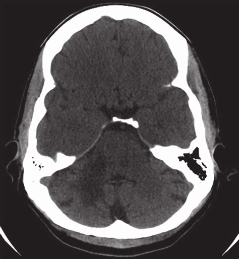 Plain Ct Of The Brain In The Axial Plane Demonstrates An Isolated