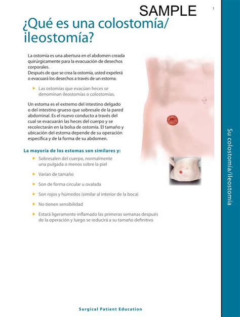 PDF SAMPLE Qué es una colostomía ileostomía PDFSLIDE NET