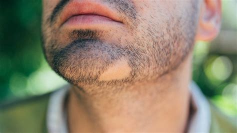 Bald Patch In Beard Causes And Treatments