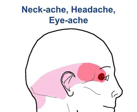 Pain Behind Ear And Neck And Headache Headache