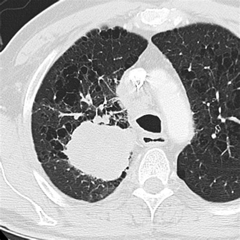 Small Cell Lung Carcinoma Staging Imaging And Treatment
