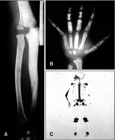 A B Roentgenogaraphic Examination Of The Left Arm Shows Diffuse Bony