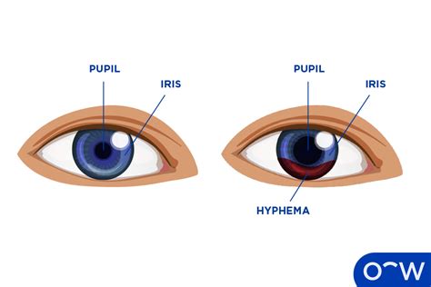 Eye Bleeding Hyphema Definition Causes Symptoms Risk Factor And