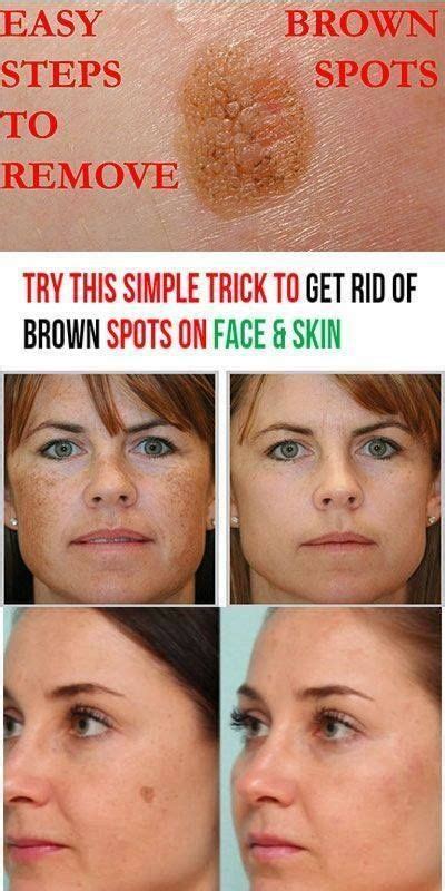How To Get Rid Of Brown Spots On Face And Hands Facial Masks Brown