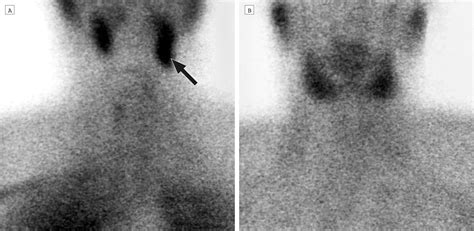 Appearance Of Ectopic Undescended Inferior Parathyroid Adenomas On