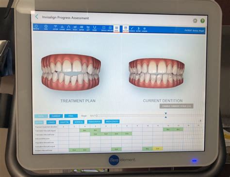 Invisalign Progress Update And Q And A Trusted General Cosmetic