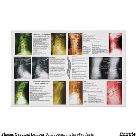 Phases Cervical Lumbar Spinal Degeneration Poster Zazzle Spinal
