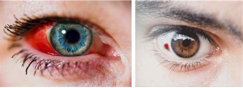 Subconjunctival Hemorrhage Cypress Eye Centre