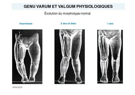 Genu Valgum Genu Varum Physiologiques