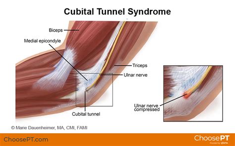 Guide Physical Therapy Guide To Cubital Tunnel Syndrome 2023
