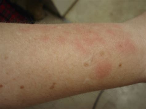 As My Fibro World Turns Red Thick Scaly Rash Photos