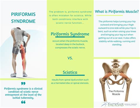 Piriformis Syndrome Pain Pattern
