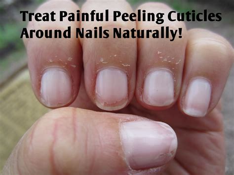 The 25 Best Peeling Cuticles Ideas On Pinterest