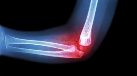 Elbow Injuries And Treatment Info Howard J Luks Md