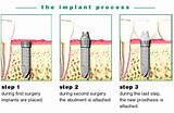Photos of Dental Implant Steps Pictures