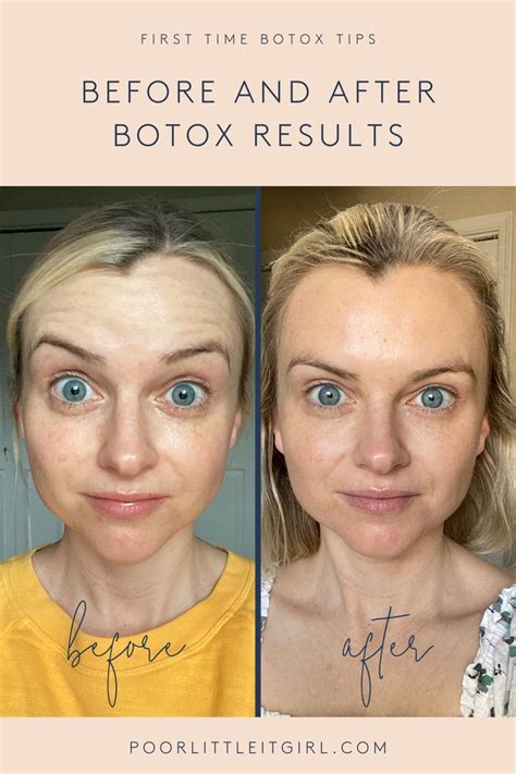 First Time Botox Tips Botox Before And After Poor Little It Girl
