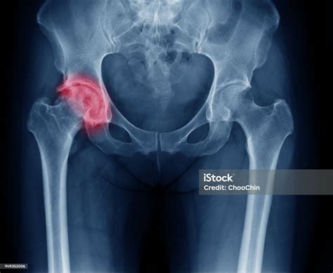 Xray Image Of Painful Hip In Woman Present Osteoarthritis Right Hip