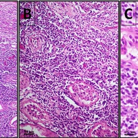 Pdf Case Report Primary Testicular Diffuse Large B Cell Lymphoma From