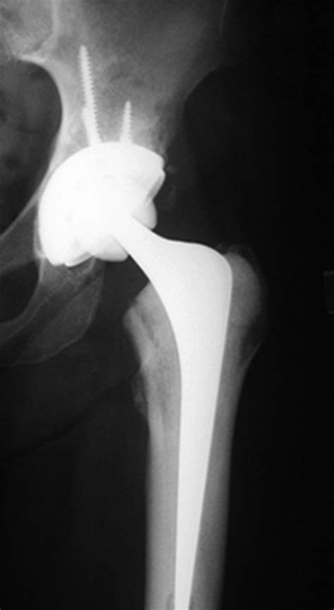 Ten Year Results Of A Double Heat Treated Metal On Metal Hip