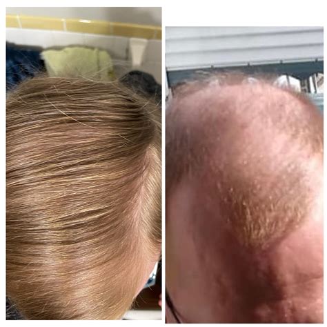 14 Months Hrt Effect On Hair At 39 Yo Rtranstimelines