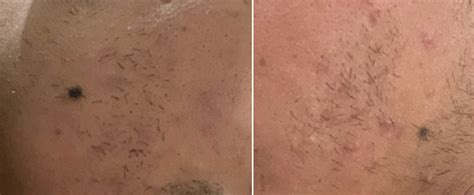 Skin Pigmentation Treatments Using Laser Facials Quiklaser Vancouver