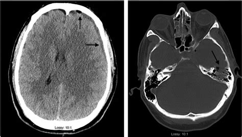 Subdural empyema with pneumocephaly from acute mastoiditis in a healthy ...