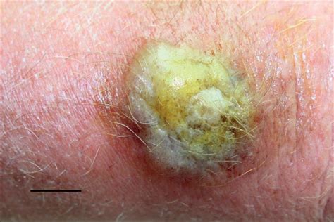 Orf Ecthyma Contagiosum In A Sheep And A Shepherd The Lancet