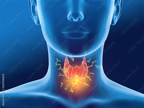 Antibodies Attacking Thyroid Gland Of A Woman Autoimmune Thyroiditis
