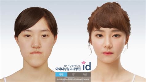 ID Hospital Korea: Korea Orthognathic Surgery, Double Jaw Surgery, Two Jaw Surgery, Jaw Surgery