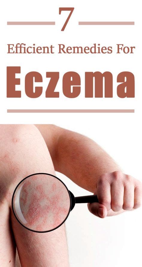 7 Efficient Remedies For Eczema Eczema Remedies Eczema Clear Skin