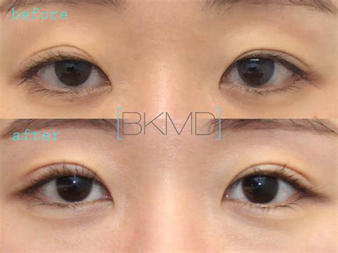 Before And After Plastic Surgery Concept Double Eyelid On Asian Woman