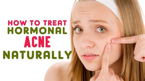 How to treat hormonal acne naturally | Acne remedies, Home remedies for acne, Natural acne remedies