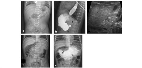 Two Different Patients With Gastric Outlet Obstruction Upper Row